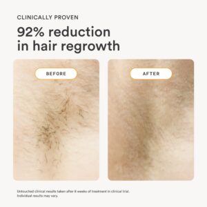Nood Flasher 2.0 — IPL Laser Hair Removal Device for Women & Men — Pain-Free & Permanent Results - Image 3